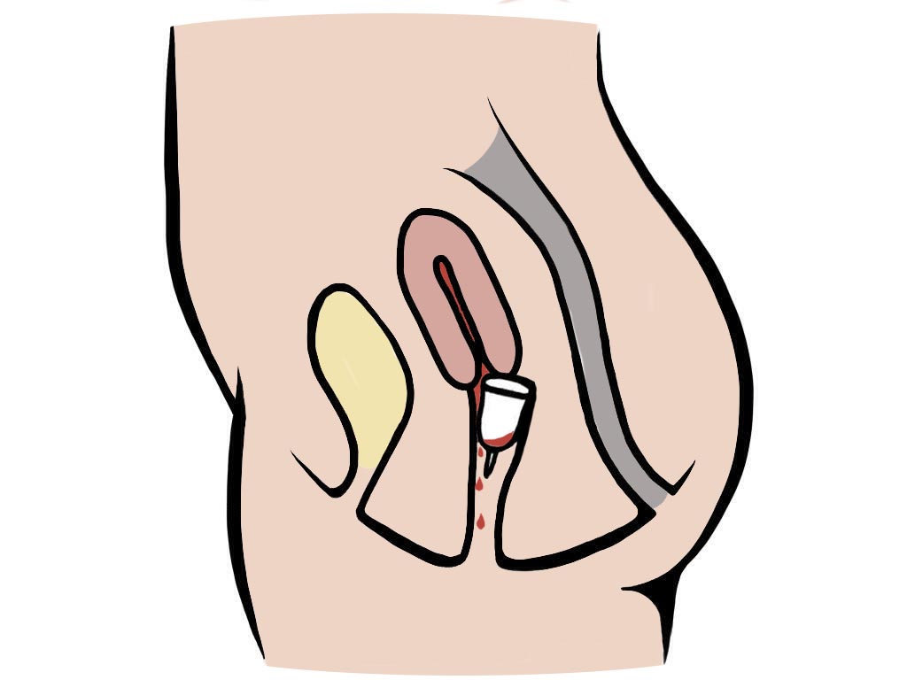 How to stop menstrual cup leaking Pixie Cup