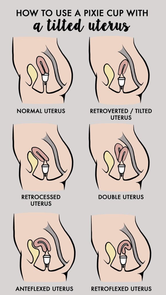 And tipped tampons uterus Tilted Uterus: