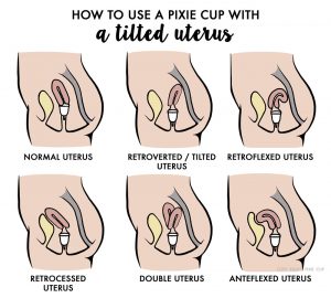 How to use a pixie menstrual cup with a tilted, retroverted, retrocessed, retroflexed, double and antiflexed uterus or cervix.