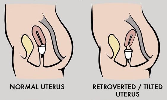 Tilted uterus regular uterus