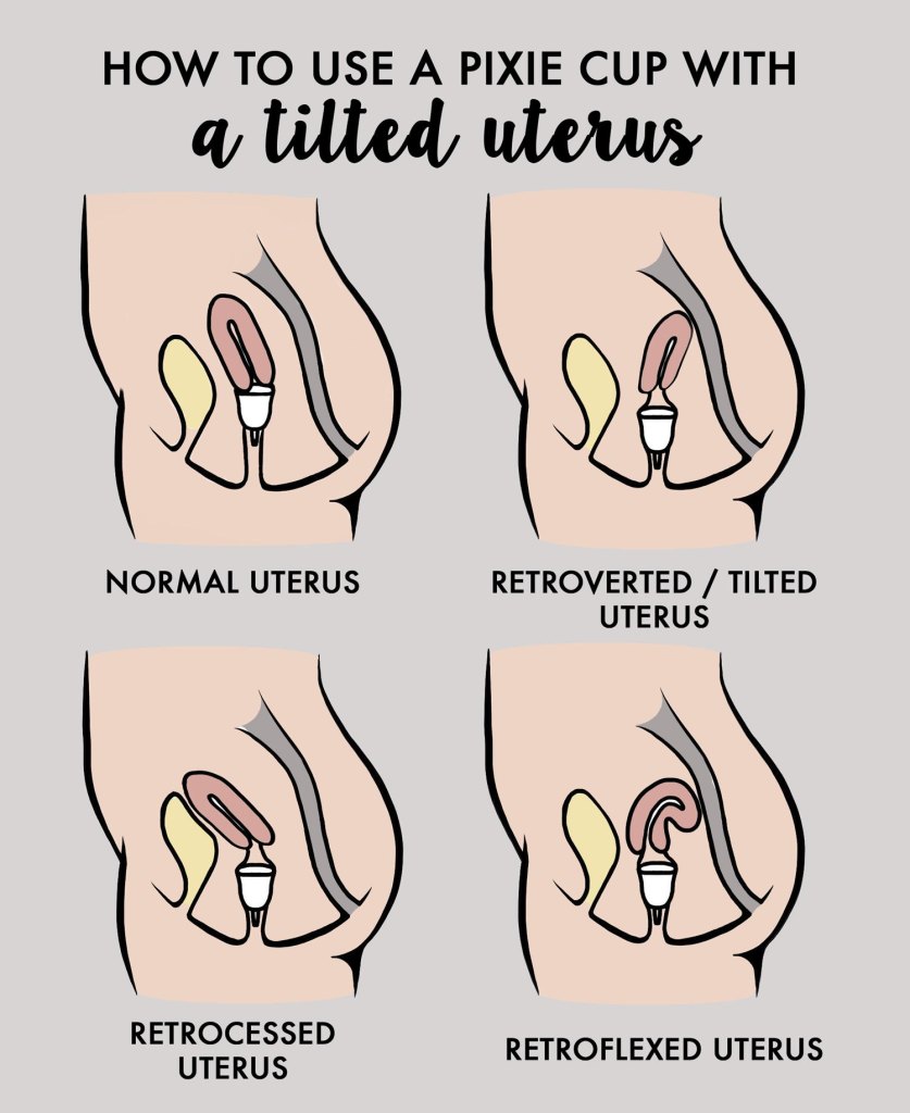 How to use a menstrual cup with a tilted uterus
