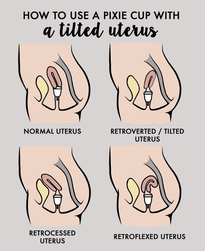 How do use a cup with a uterus? - Pixie Cup