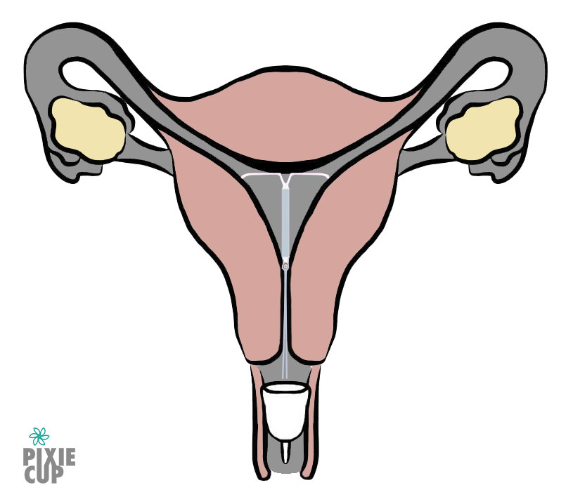menstrual cup with an IUD