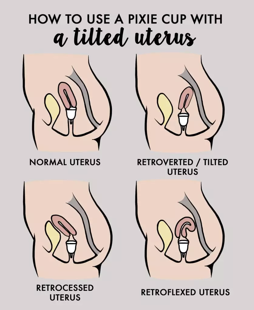 How do I use a menstrual cup with a tilted uterus? - Pixie Cup